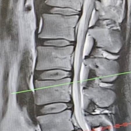 Vyhřezlá ploténka Filipa Turka